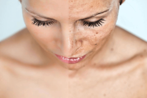 acne-littekens voor en na